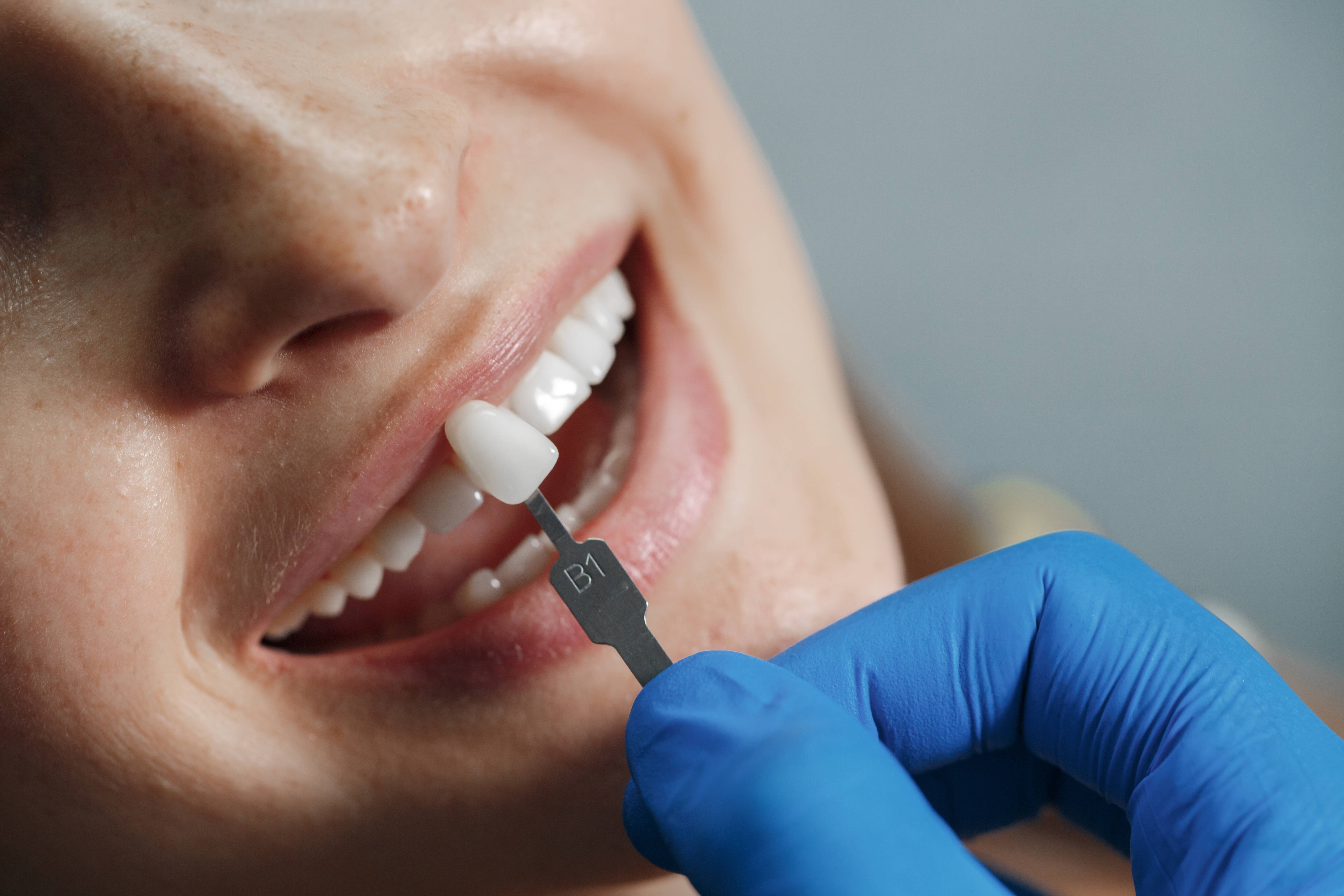 Dental crown treatment