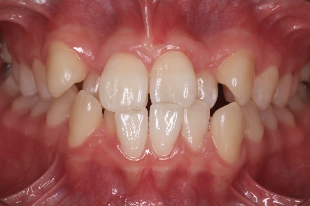 BEFORE treatment