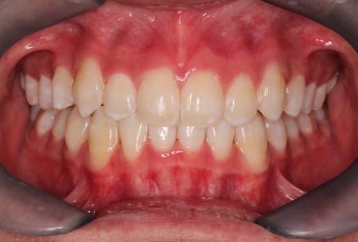 AFTER treatment