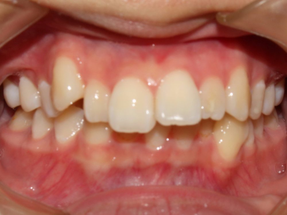 BEFORE treatment