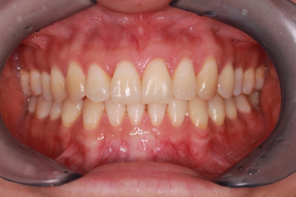 AFTER treatment