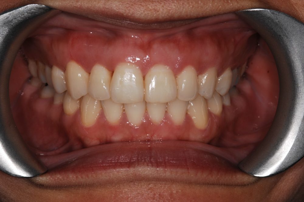 AFTER treatment