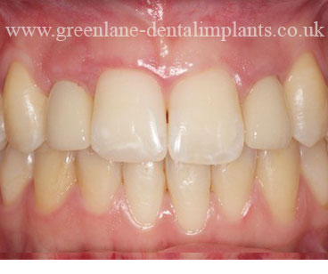 AFTER treatment