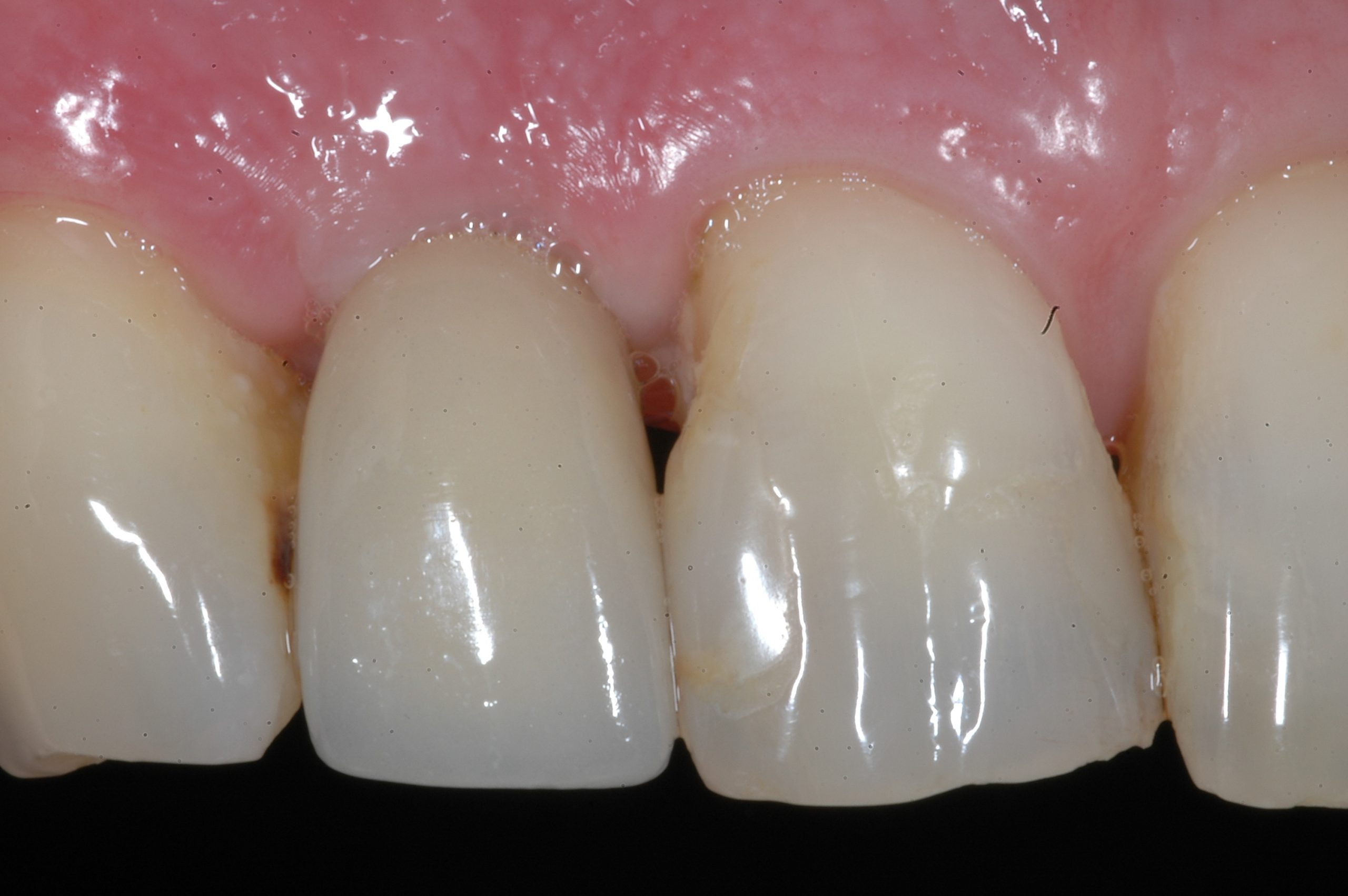 AFTER treatment