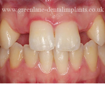BEFORE treatment