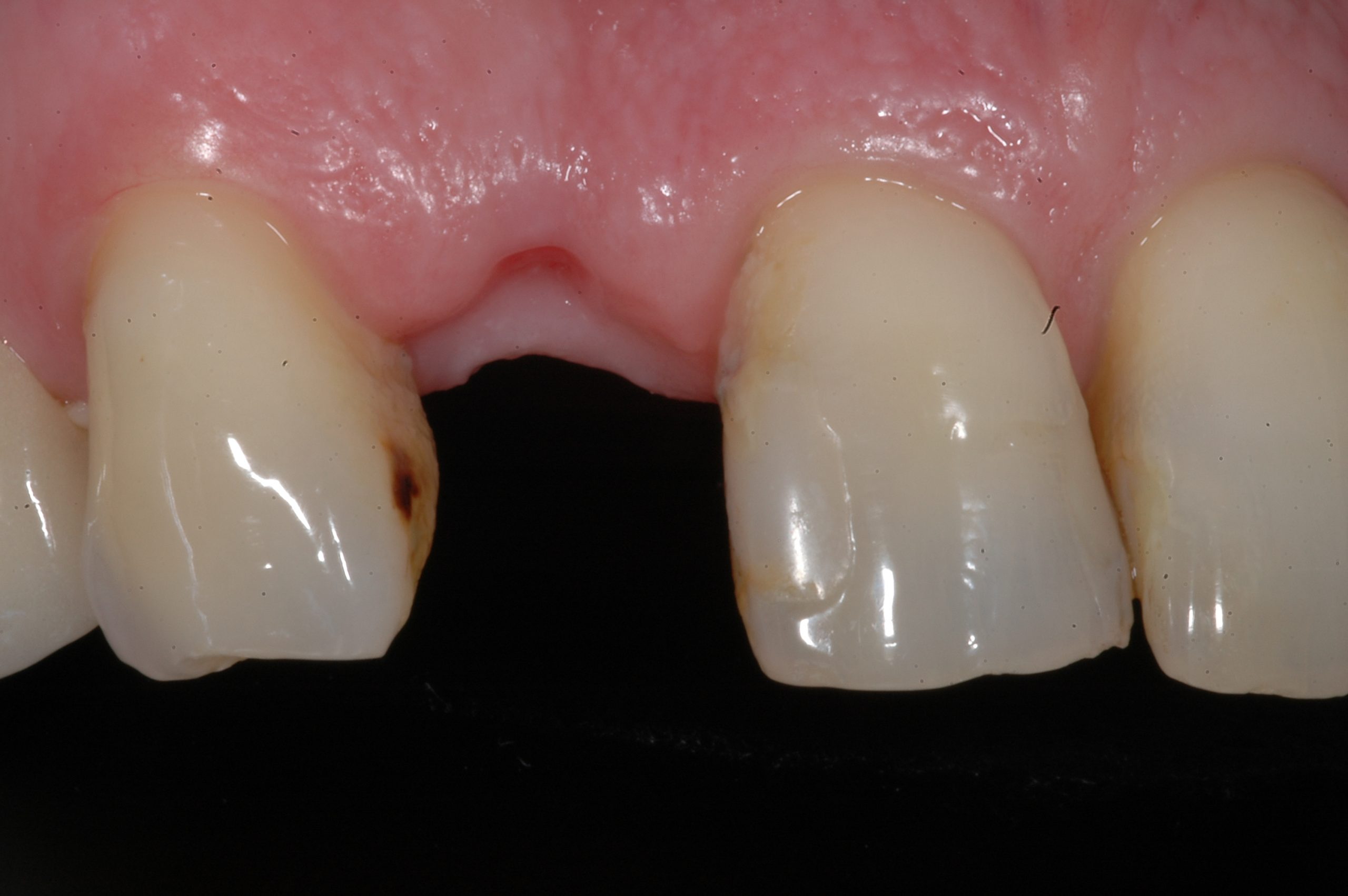 BEFORE treatment