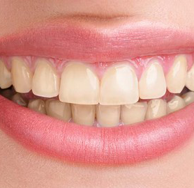 BEFORE treatment