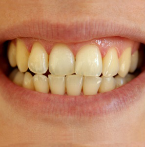 BEFORE treatment